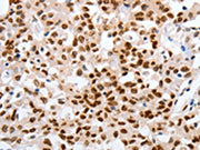 The image on the left is immunohistochemistry of paraffin-embedded Human lung cancer tissue using CSB-PA029874(MUTYH Antibody) at dilution 1/25, on the right is treated with fusion protein. (Original magnification: ×200)