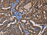 The image on the left is immunohistochemistry of paraffin-embedded Human thyroid cancer tissue using CSB-PA030360(EPHB6 Antibody) at dilution 1/40, on the right is treated with fusion protein. (Original magnification: ×200)