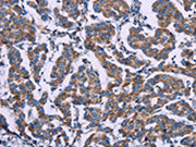 The image on the left is immunohistochemistry of paraffin-embedded Human breast cancer tissue using CSB-PA030856(AGFG1 Antibody) at dilution 1/50, on the right is treated with fusion protein. (Original magnification: ×200)