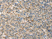 The image on the left is immunohistochemistry of paraffin-embedded Human liver cancer tissue using CSB-PA030905(TPSB2 Antibody) at dilution 1/20, on the right is treated with fusion protein. (Original magnification: ×200)
