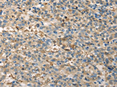 The image on the left is immunohistochemistry of paraffin-embedded Human liver cancer tissue using CSB-PA030905(TPSB2 Antibody) at dilution 1/20, on the right is treated with fusion protein. (Original magnification: ×200)