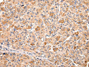 The image on the left is immunohistochemistry of paraffin-embedded Human liver cancer tissue using CSB-PA030941(RERE Antibody) at dilution 1/20, on the right is treated with synthetic peptide. (Original magnification: ×200)