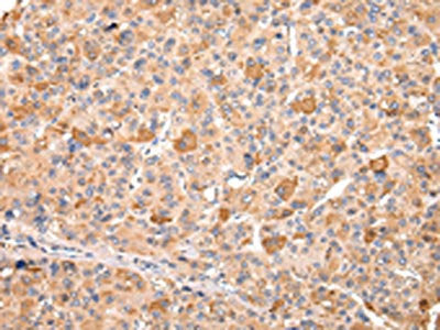 The image on the left is immunohistochemistry of paraffin-embedded Human liver cancer tissue using CSB-PA030941(RERE Antibody) at dilution 1/20, on the right is treated with synthetic peptide. (Original magnification: ×200)