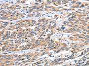 The image on the left is immunohistochemistry of paraffin-embedded Human esophagus cancer tissue using CSB-PA030984(CGB Antibody) at dilution 1/60, on the right is treated with fusion protein. (Original magnification: ×200)