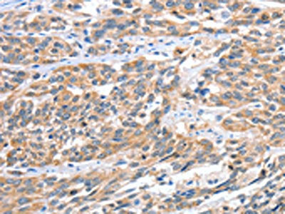 The image on the left is immunohistochemistry of paraffin-embedded Human esophagus cancer tissue using CSB-PA030984(CGB Antibody) at dilution 1/60, on the right is treated with fusion protein. (Original magnification: ×200)
