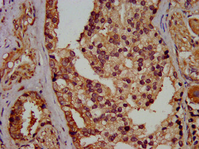 IHC image of CSB-PA03099A0Rb diluted at 1:400 and staining in paraffin-embedded human prostate cancer performed on a Leica BondTM system. After dewaxing and hydration, antigen retrieval was mediated by high pressure in a citrate buffer (pH 6.0). S...