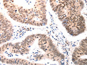 The image on the left is immunohistochemistry of paraffin-embedded Human colon cancer tissue using CSB-PA031026(BDKRB2 Antibody) at dilution 1/50, on the right is treated with synthetic peptide. (Original magnification: ×200)