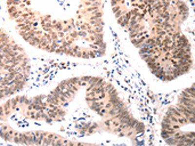 The image on the left is immunohistochemistry of paraffin-embedded Human colon cancer tissue using CSB-PA031026(BDKRB2 Antibody) at dilution 1/50, on the right is treated with synthetic peptide. (Original magnification: ×200)