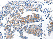 The image on the left is immunohistochemistry of paraffin-embedded Human lung cancer tissue using CSB-PA031049(Ccl6 Antibody) at dilution 1/50, on the right is treated with synthetic peptide. (Original magnification: ×200)