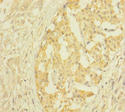 Immunohistochemistry of paraffin-embedded human pancreatic cancer using CSB-PA03147A0Rb at dilution of 1:100