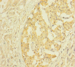 Immunohistochemistry of paraffin-embedded human pancreatic cancer using CSB-PA03147A0Rb at dilution of 1:100