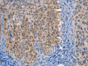The image on the left is immunohistochemistry of paraffin-embedded Human cervical cancer tissue using CSB-PA031673(UCK1 Antibody) at dilution 1/50, on the right is treated with fusion protein. (Original magnification: ×200)
