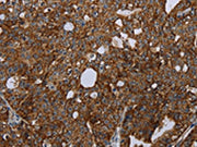 The image on the left is immunohistochemistry of paraffin-embedded Human ovarian cancer tissue using CSB-PA031676(HMGCR Antibody) at dilution 1/20, on the right is treated with fusion protein. (Original magnification: ×200)