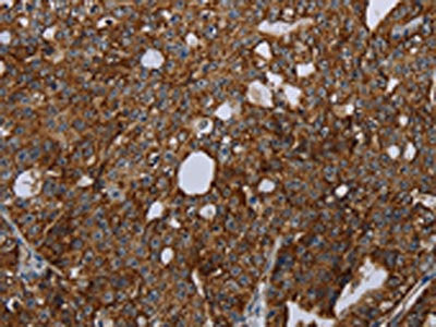 The image on the left is immunohistochemistry of paraffin-embedded Human ovarian cancer tissue using CSB-PA031676(HMGCR Antibody) at dilution 1/20, on the right is treated with fusion protein. (Original magnification: ×200)