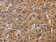 The image on the left is immunohistochemistry of paraffin-embedded Human liver cancer tissue using CSB-PA031920(NCR3 Antibody) at dilution 1/40, on the right is treated with fusion protein. (Original magnification: ×200)