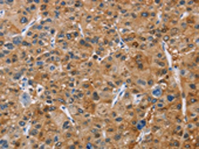 The image on the left is immunohistochemistry of paraffin-embedded Human liver cancer tissue using CSB-PA031920(NCR3 Antibody) at dilution 1/40, on the right is treated with fusion protein. (Original magnification: ×200)