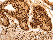 The image on the left is immunohistochemistry of paraffin-embedded Human colon cancer tissue using CSB-PA031927(E2F7 Antibody) at dilution 1/60, on the right is treated with synthetic peptide. (Original magnification: ×200)