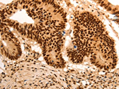 The image on the left is immunohistochemistry of paraffin-embedded Human colon cancer tissue using CSB-PA031927(E2F7 Antibody) at dilution 1/60, on the right is treated with synthetic peptide. (Original magnification: ×200)