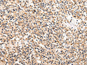 The image on the left is immunohistochemistry of paraffin-embedded Human prostate cancer tissue using CSB-PA032081(USP5 Antibody) at dilution 1/25, on the right is treated with fusion protein. (Original magnification: ×200)