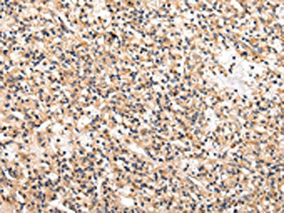 The image on the left is immunohistochemistry of paraffin-embedded Human prostate cancer tissue using CSB-PA032081(USP5 Antibody) at dilution 1/25, on the right is treated with fusion protein. (Original magnification: ×200)