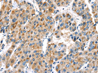 The image on the left is immunohistochemistry of paraffin-embedded Human liver cancer tissue using CSB-PA032095(UCP2 Antibody) at dilution 1/20, on the right is treated with synthetic peptide. (Original magnification: ×200)
