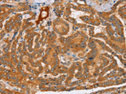 The image on the left is immunohistochemistry of paraffin-embedded Human thyroid cancer tissue using CSB-PA032170(PEA15 Antibody) at dilution 1/25, on the right is treated with fusion protein. (Original magnification: ×200)