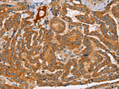 The image on the left is immunohistochemistry of paraffin-embedded Human thyroid cancer tissue using CSB-PA032170(PEA15 Antibody) at dilution 1/25, on the right is treated with fusion protein. (Original magnification: ×200)