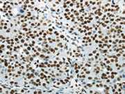 The image on the left is immunohistochemistry of paraffin-embedded Human breast cancer tissue using CSB-PA032302(HNRNPM Antibody) at dilution 1/25, on the right is treated with synthetic peptide. (Original magnification: ×200)