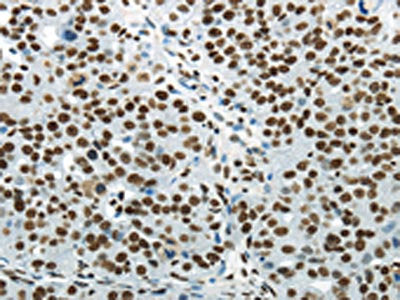 The image on the left is immunohistochemistry of paraffin-embedded Human breast cancer tissue using CSB-PA032302(HNRNPM Antibody) at dilution 1/25, on the right is treated with synthetic peptide. (Original magnification: ×200)