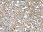 The image on the left is immunohistochemistry of paraffin-embedded Human breast cancer tissue using CSB-PA032305(BPIFB2 Antibody) at dilution 1/50, on the right is treated with synthetic peptide. (Original magnification: ×200)