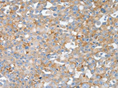 The image on the left is immunohistochemistry of paraffin-embedded Human breast cancer tissue using CSB-PA032305(BPIFB2 Antibody) at dilution 1/50, on the right is treated with synthetic peptide. (Original magnification: ×200)