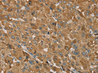 The image on the left is immunohistochemistry of paraffin-embedded Human liver cancer tissue using CSB-PA032351(TRIM40 Antibody) at dilution 1/35, on the right is treated with synthetic peptide. (Original magnification: ×200)