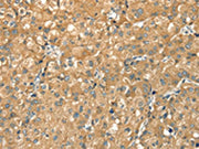 The image on the left is immunohistochemistry of paraffin-embedded Human liver cancer tissue using CSB-PA032471(CWC27 Antibody) at dilution 1/20, on the right is treated with synthetic peptide. (Original magnification: ×200)