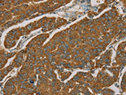 The image on the left is immunohistochemistry of paraffin-embedded Human breast cancer tissue using CSB-PA032496(NPPB Antibody) at dilution 1/30, on the right is treated with fusion protein. (Original magnification: ×200)