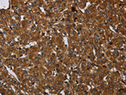 The image on the left is immunohistochemistry of paraffin-embedded Human prostate cancer tissue using CSB-PA032562(ARHGEF12 Antibody) at dilution 1/20, on the right is treated with synthetic peptide. (Original magnification: ×200)