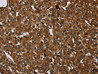 The image on the left is immunohistochemistry of paraffin-embedded Human prostate cancer tissue using CSB-PA032562(ARHGEF12 Antibody) at dilution 1/20, on the right is treated with synthetic peptide. (Original magnification: ×200)