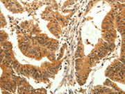 The image on the left is immunohistochemistry of paraffin-embedded Human colon cancer tissue using CSB-PA032588(TRPM7 Antibody) at dilution 1/30, on the right is treated with synthetic peptide. (Original magnification: ×200)