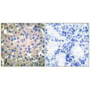 Immunohistochemical analysis of paraffin-embedded human breast carcinoma tissue using Transglutaminase 2 antibody.