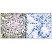 Immunohistochemical analysis of paraffin-embedded human breast carcinoma tissue using Transglutaminase 2 antibody.