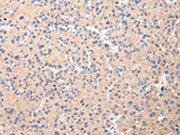 The image on the left is immunohistochemistry of paraffin-embedded Human liver cancer tissue using CSB-PA032749(DUSP11 Antibody) at dilution 1/25, on the right is treated with fusion protein. (Original magnification: ×200)