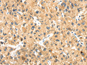 The image on the left is immunohistochemistry of paraffin-embedded Human liver cancer tissue using CSB-PA032798(LLGL2 Antibody) at dilution 1/20, on the right is treated with synthetic peptide. (Original magnification: ×200)