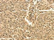 The image on the left is immunohistochemistry of paraffin-embedded Human lung cancer tissue using CSB-PA033044(SEPT2 Antibody) at dilution 1/30, on the right is treated with fusion protein. (Original magnification: ×200)