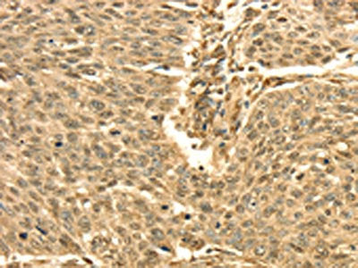 The image on the left is immunohistochemistry of paraffin-embedded Human lung cancer tissue using CSB-PA033044(SEPT2 Antibody) at dilution 1/30, on the right is treated with fusion protein. (Original magnification: ×200)