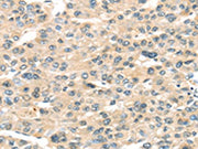 The image on the left is immunohistochemistry of paraffin-embedded Human liver cancer tissue using CSB-PA033077(HAUS7 Antibody) at dilution 1/30, on the right is treated with synthetic peptide. (Original magnification: ×200)