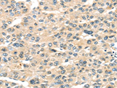 The image on the left is immunohistochemistry of paraffin-embedded Human liver cancer tissue using CSB-PA033077(HAUS7 Antibody) at dilution 1/30, on the right is treated with synthetic peptide. (Original magnification: ×200)