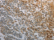 The image on the left is immunohistochemistry of paraffin-embedded Human tonsil tissue using CSB-PA033184(INHA Antibody) at dilution 1/150, on the right is treated with fusion protein. (Original magnification: ×200)