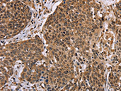 The image on the left is immunohistochemistry of paraffin-embedded Human cervical cancer tissue using CSB-PA033256(EDN2 Antibody) at dilution 1/30, on the right is treated with fusion protein. (Original magnification: ×200)