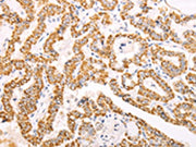The image on the left is immunohistochemistry of paraffin-embedded Human thyroid cancer tissue using CSB-PA033338(ATPIF1 Antibody) at dilution 1/60, on the right is treated with fusion protein. (Original magnification: ×200)