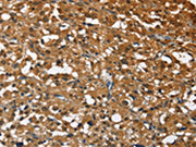 The image on the left is immunohistochemistry of paraffin-embedded Human thyroid cancer tissue using CSB-PA033399(STK17B Antibody) at dilution 1/40, on the right is treated with fusion protein. (Original magnification: ×200)