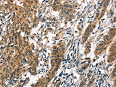 The image on the left is immunohistochemistry of paraffin-embedded Human gastic cancer tissue using CSB-PA033427(SMAD3 Antibody) at dilution 1/30, on the right is treated with synthetic peptide. (Original magnification: ×200)